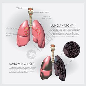 肺癌图解矢量说明背景图片