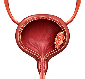 人体膀胱癌是一种尿道解剖器官疾病恶细胞概念是3D插图切除身体解剖图片