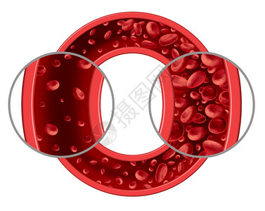 贫血和病医学图表概念是正常和异的血细胞计数动脉或血管中的人体循环是3D插图孤立在白色背景上图片