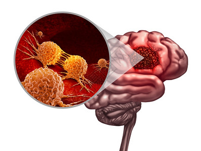 脑癌解剖概念和恶肿瘤或象征作为神经学身体的一部分恶细胞以3D插图元素分裂和扩散的微放大作用背景图片