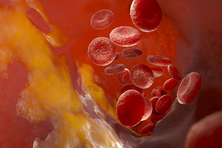 动脉血液容器和流动细胞中的胆酯醇板3D说明动脉中的胆酯醇板图片