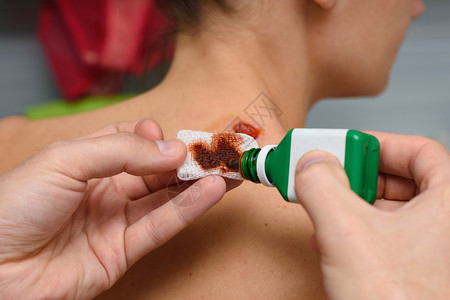 在绷带上施用抗菌药物治疗女孩颈部的伤口图片