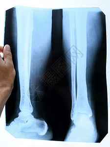 将钢连接板脱去后腿骨折碎对进行X光X检查图片