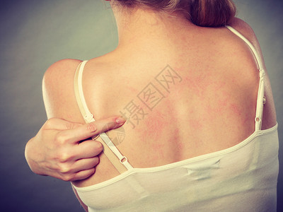 年轻女皮肤病和过敏疹症状显示她有痒的背部图片