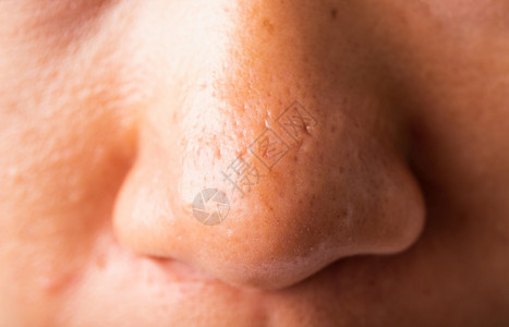 亚洲年轻女子大孔有雀斑脸颊油鼻子图片