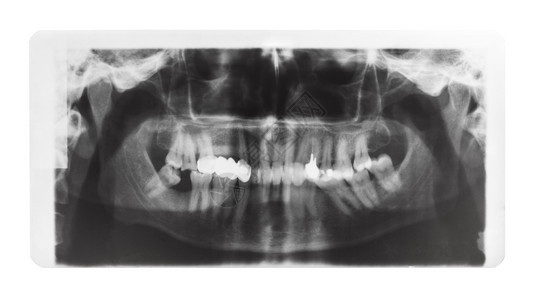 以X光胶片拍摄人类下巴的X光图像牙齿冠和白背景孤立的牙齿针图片