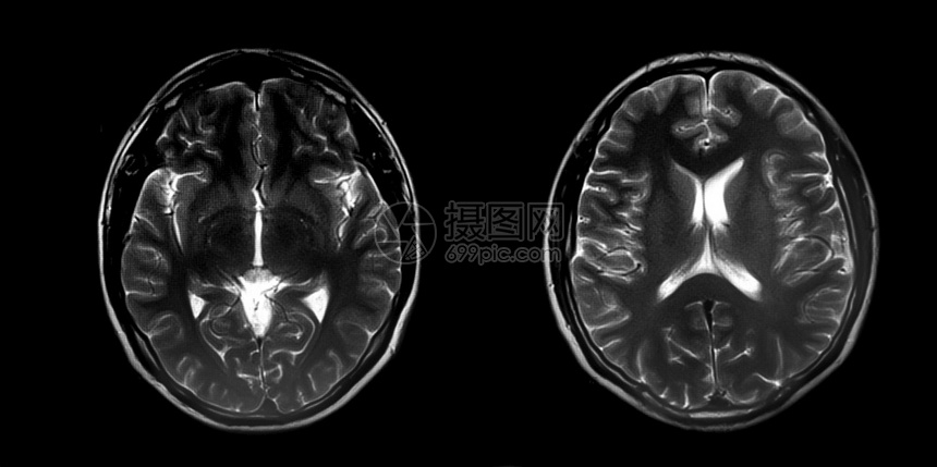 黑色的谐振正常大脑磁共振图像MRI全光脑断层摄影健康图片