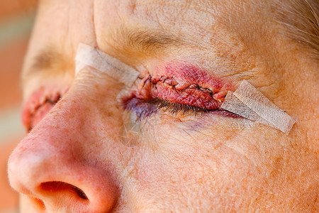 舍内维尔出血细节闭合眼睑矫正的睛和鼻子图片
