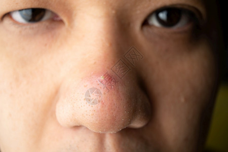 关闭了亚洲皮肤脸部鼻子上许多黑头皮条和肛门伤疤美丽瘢痕细节图片