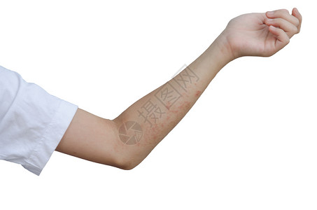 Rash和手臂上的皮肤在白色背景上被孤立卫生保健表皮传染图片