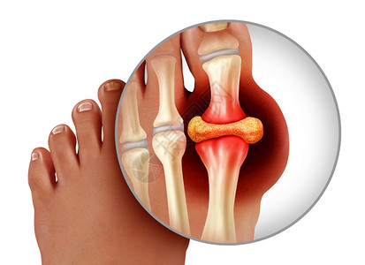 一种手术以3D插图样式作为治疗和诊断白种背景孤立的慢疼痛高血糖贫象征指脚趾紧贴人的作为治疗和诊断白种背景下的慢疼痛标志类风湿背景图片