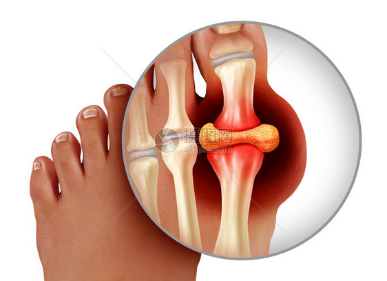 一种手术以3D插图样式作为治疗和诊断白种背景孤立的慢疼痛高血糖贫象征指脚趾紧贴人的作为治疗和诊断白种背景下的慢疼痛标志类风湿图片