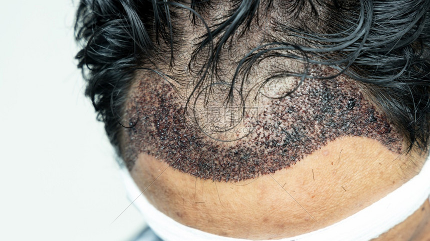 医疗的院头部做发移植手术的人有后发线FUUE软体细胞抽取理发手术类型及其各阶段的头发移植手术者关心图片