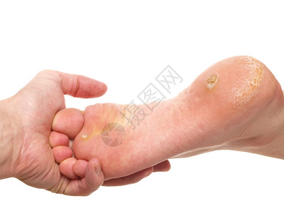考试按摩脚丫子皮肤学家检查一脚的骨和干皮肤向白图片