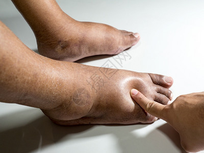 患有糖尿病沉闷和肿胀的人脚部由于被放在白背景上的糖尿手指打在糖尿病足背上以测试脚肿胀受伤肮脏的白色背景