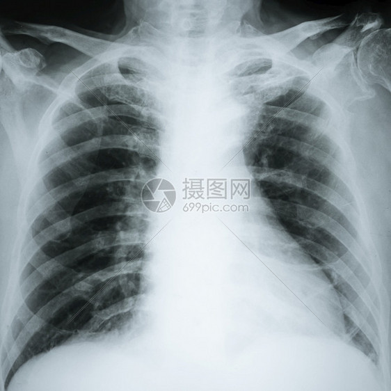 关心临床X射线辐图象Chest报告医疗诊断保健和概念成人图片