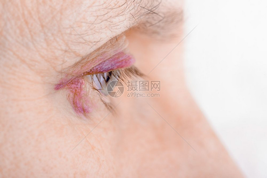 女紫色的瓜拉纳皮由于毛细管破裂造成血肿或瘀伤而受的妇女眼部也可能是结膜炎或其他过敏眼睛炎艾滋图片