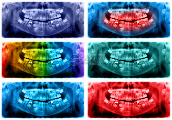 脸颚骨全景X光片是上颌骨和下的扫描牙科光片照显示一个7岁的孩子彩色图像全景牙科光片洞图片