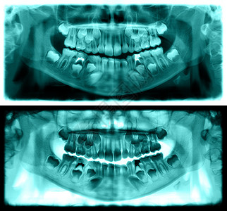 宝马X7牛奶龋齿光谱射线仪是一种扫描牙科X光片对上下巴进行检查该照片显示一名7岁儿童的年龄为7岁红图象全景牙医X光片X射线背景