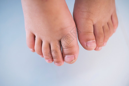 治疗在最大的脚趾ToenailFungus上脚踩着一个破碎和脱皮的脚指甲一种创伤图片