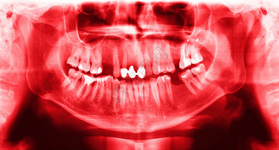 颚骨光谱射电仪是上下巴的扫描牙科X光片该照显示一名307岁的年轻人机器脸图片