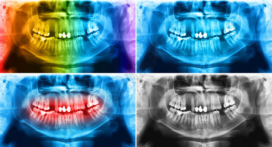 光谱射电仪是一种扫描牙科X光片对上下脊椎进行检查该照片显示一名年龄在37岁的轻人用X光扫瞄牙齿打人头骨下颌面部的陈年图片