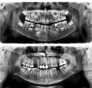 宝马X7基本的上颌骨光谱射线仪PanoramiccentryXray是一对30岁7的年轻人牙齿X射线根小牛背景