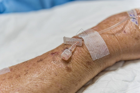 手术输液康复医院内对一名年长病人的手进行盐碱静脉注射的病人在医院内对患有盐碱静脉注射的病人图片