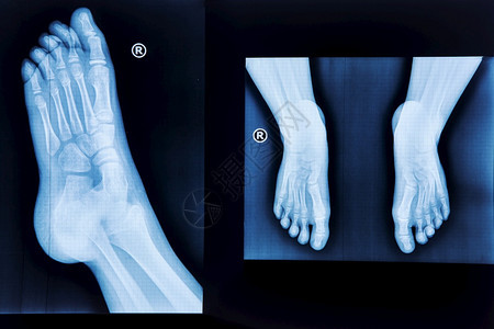 扫描电影正常的足放射医疗诊断创伤学和矫形外科等X射线诊所图片