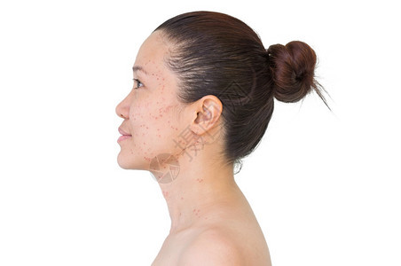移动沙龙亚洲妇女激光治疗的面部和颈激光处理器皮肤雀斑和黑暗点产生的烧或沙巴皮肤科图片
