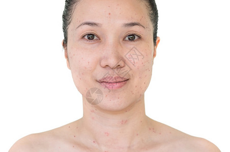 美丽的亚洲妇女激光治疗的面部和颈激光处理器皮肤雀斑和黑暗点产生的烧或沙巴衰老龙图片
