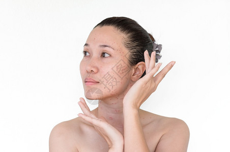 沙龙按摩亚洲妇女激光治疗的面部和颈激光处理器皮肤雀斑和黑暗点产生的烧或沙巴背部图片