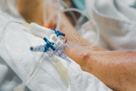 生活医疗的80s流感19do气管切除手术用呼吸机在特护病房ICU室急诊的病人床上呼吸帮助在医院进行生命概念保健病人在医院做气管切图片