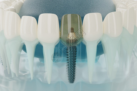 嘴半透明手术牙科植入器的密闭组件透明3D转换图片