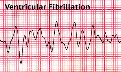 治疗心血管纤维裂变VF是一种情况在这状态中内室肌肉的脏收缩不协调使其颤动而不是正常结合只能通过心电图学证实这是一种医疗紧急情图片