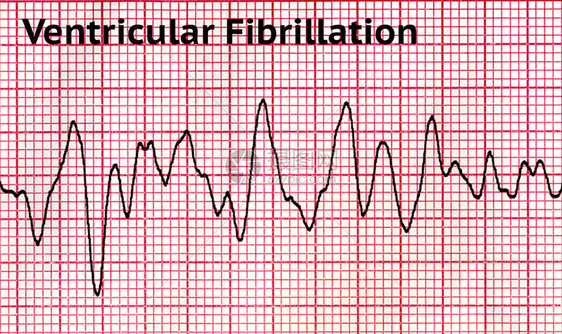 治疗心血管纤维裂变VF是一种情况在这状态中内室肌肉的脏收缩不协调使其颤动而不是正常结合只能通过心电图学证实这是一种医疗紧急情图片