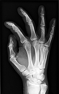 X射线手手语痛风手指关节病x光腕关节手腕软骨图片