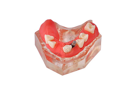 有植入的下巴假肢白色牙龈牙科印象牙齿假牙背景图片
