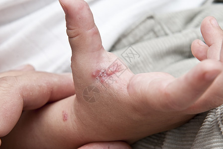 一只幼崽手抓着雌激素透明带手臂痛苦治疗粉刺疾病感染孩子婴儿症状图片