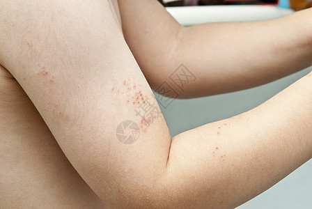 儿童臂中的疹子身体孩子治疗结痂痛苦粉刺手臂病理感染婴儿图片