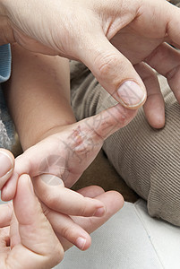 一只幼崽手抓着雌激素皮肤科治疗粉刺感染身体孩子结痂水泡症状疾病图片
