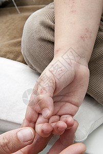 一只幼崽手抓着雌激素水泡皮肤科透明带身体治疗结痂症状病理痛苦发烧图片