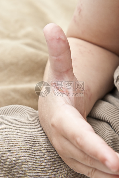 一只幼崽手抓着雌激素身体孩子皮肤科病理婴儿粉刺透明带痛苦发烧皮肤图片