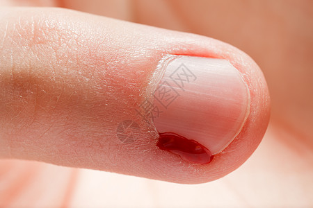 血伤口指甲援助癌症疼痛美甲身体卫生瘢痕帮助倒刺皮肤图片