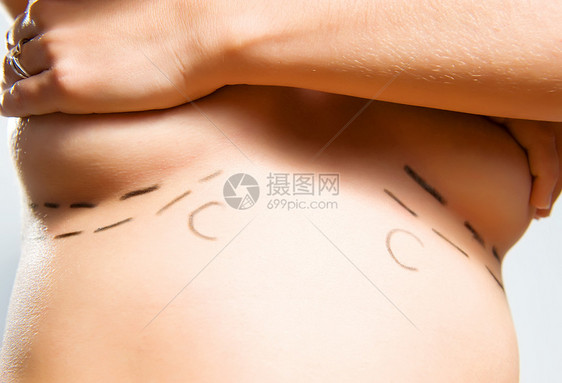 用于整容外科手术的胸下标记图片