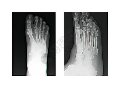 人体腿骨X光片测试渗透骨骼摄影脚趾外科正方形公用事业疾病放射科图片