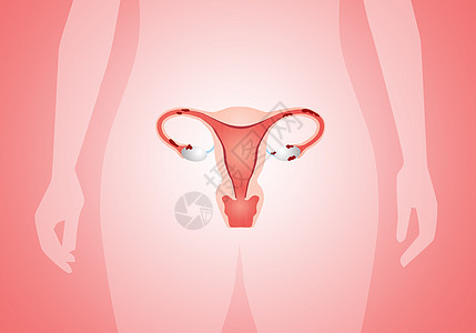 子宫内硬化治愈卫生丝带斗争药品女性疾病粉色治疗疼痛图片