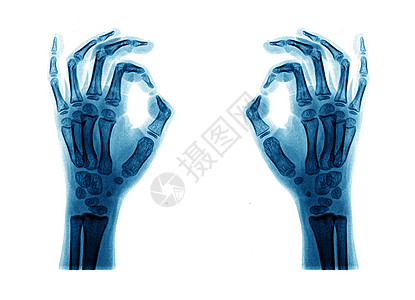 X射线手事故疾病拇指诊断身体半径关节手指x光骨科高清图片