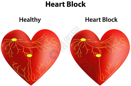 心心块中庭疾病心脏病学心电图生理节点心肌系统心脏房室图片