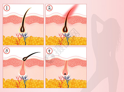 永久脱发损失沙龙插图乳突休息皮肤科脱毛无毛美丽化期图片
